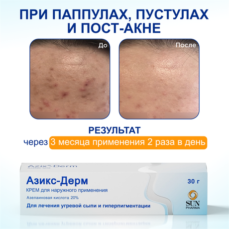 Фото Азикс-Дерм, крем 20% 30 г, 1 шт.